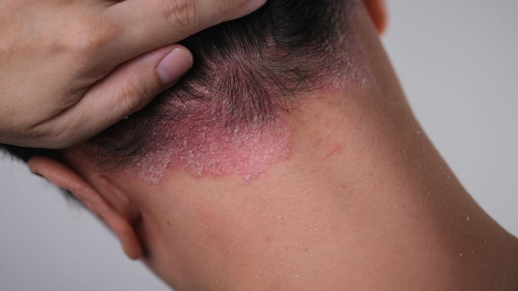 dermatologia clínica | Imagem: Pessoa de pele branca, em plano de detalhe (close-up) focado na região posterior da cabeça, nuca e pescoço, vista de costas. Uma das mãos afasta o cabelo escuro para revelar o couro cabeludo na linha de implantação capilar posterior. A pele apresenta uma lesão dermatológica bem delimitada, caracterizada por uma placa eritematosa (avermelhada) e espessa, densamente coberta por escamas esbranquiçadas e descamação seca prateada, típica de um quadro de psoríase capilar. Há pequenos fragmentos de escamas dispersos pela pele do pescoço.