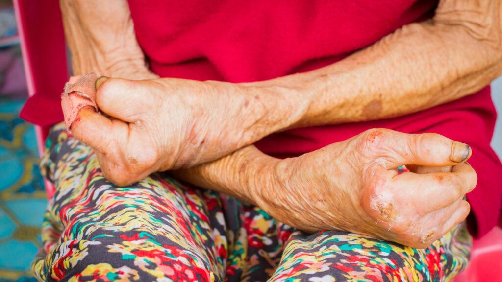 dermatologia clínica | Imagem: Pessoa de pele clara e idosa, em plano médio focado em seus braços e mãos, que aparecem cruzados sobre o colo. Há uma severa deformidade anatômica bilateral nas extremidades dos membros superiores, compatível com sequelas graves de hanseníase (mal de Hansen). Os dedos das mãos apresentam encurtamento significativo, reabsorção óssea (mutilação) e perda de falanges. Na mão esquerda (à esquerda da imagem), o polegar remanescente está protegido por uma bandagem improvisada; na mão direita (à direita da imagem), as extremidades dos dedos apresentam pele espessa, calosidades, pequenas feridas e unhas distróficas/escuras. A pele dos antebraços é bastante enrugada e apresenta manchas senis. O indivíduo veste uma camiseta vermelha e calça estampada colorida, sentado em uma cadeira vermelha com fundo parcialmente visível e desfocado.