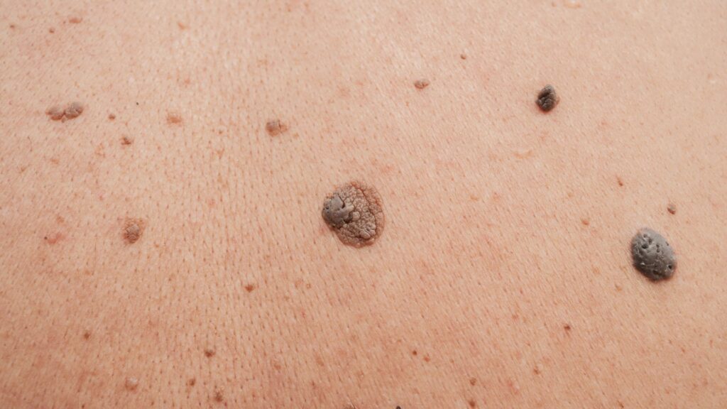dermatologia clínica | Imagem: Pessoa de pele clara, em plano de detalhe (macro/close-up) focado em uma região do corpo (como o dorso ou abdômen) que apresenta múltiplas lesões dermatológicas. Destacam-se ceratoses seborreicas e nevos melanocíticos (pintas) de diferentes tamanhos e colorações dispersos pela pele. No centro, há uma lesão arredondada, ligeiramente saliente, de tom acastanhado com o centro mais escuro e textura rugosa. À direita, observa-se outra lesão maior, ovalada, de cor cinza-escura/enegrecida e superfície irregular e ceratósica. Outras pequenas máculas e pápulas castanhas claras estão distribuídas ao redor.