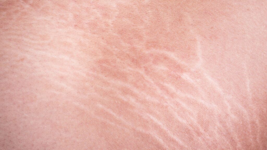 estria |  Imagem: Pessoa de pele branca, em plano de detalhe (close-up) focado em uma região do corpo que apresenta estrias. A pele exibe múltiplas linhas sinuosas, paralelas e alongadas de coloração esbranquiçada e nacarada (estrias albas), com textura sutilmente deprimida e atrófica em relação ao tecido sadio adjacente, indicando a fase tardia de estiramento cutâneo. A iluminação é uniforme, evidenciando o contraste entre o tom claro das marcas e a pele ao redor. O enquadramento é fechado, sem outros elementos visíveis de fundo.