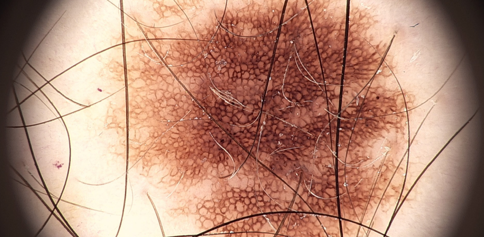 Rede Pigmentar | Imagem: Pessoa de pele clara, em plano de detalhe extremo (imagem dermatoscópica) focado em uma lesão pigmentada na pele. A imagem revela uma estrutura melanocítica (nevo/pinta) com padrão de rede pigmentar típica (reticular), caracterizada por linhas acastanhadas finas que se intercruzam formando pequenas malhas arredondadas, com pigmentação mais densa e escura no centro que clareia gradualmente em direção à periferia. Fios de cabelo escuros e finos cruzam a superfície da pele em diversas direções por cima da lesão. O campo de visão é circular com bordas escurecidas e sombreadas (vinheta), simulando a visualização direta através da lente de um dermatoscópio.