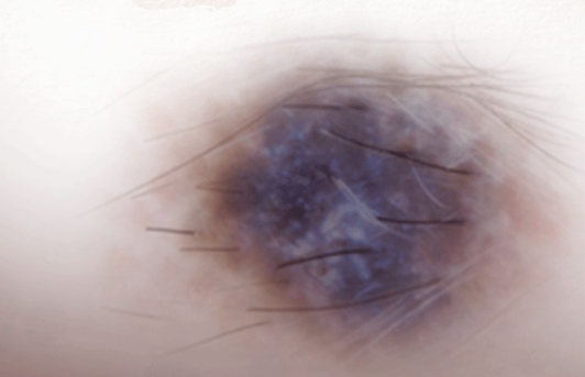 véu azul esbranquiçado | dermatoscopia |  Imagem: Pessoa de pele clara, em plano de detalhe extremo (imagem dermatoscópica) focado em uma lesão pigmentada na pele. A imagem revela uma estrutura melanocítica assimétrica, de coloração predominantemente azul-acinzentada e enegrecida no centro (característica de véu azul-esbranquiçado), com bordas irregulares e mal definidas que se misturam em tons acastanhados claros na periferia. Vários fios de cabelo escuros e finos atravessam a superfície da lesão. O campo de visão apresenta bordas esbranquiçadas e levemente sombreadas, simulando a aproximação da lente de um dermatoscópio.
