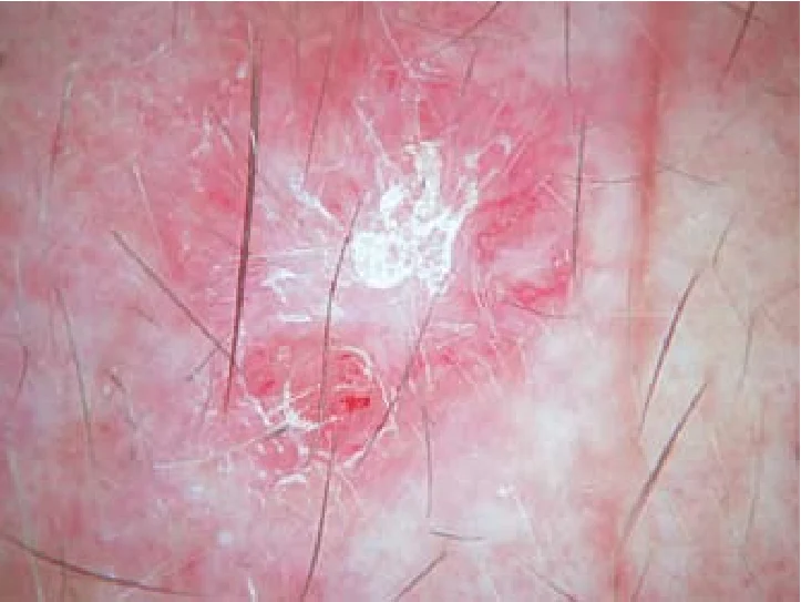 Vasos lineares-irregulares | Imagem: Pessoa de pele clara, em plano de detalhe extremo (imagem dermatoscópica) focado em uma lesão cutânea. A imagem exibe uma área central eritematosa (avermelhada) intensa e irregular, caracterizada por um padrão vascular polimorfo na periferia com vasos lineares e pontilhados evidentes sob magnificação. Na porção central da lesão, destaca-se uma área de aspecto esbranquiçado e amorfo, com escamas ou estruturas queratósicas brancas e brilhantes dispostas de forma irregular. Diversos fios de cabelo escuros, longos e finos cruzam o campo visual em diferentes direções sobre a lesão. A iluminação é homogênea, direta e focada na estrutura dermatológica.