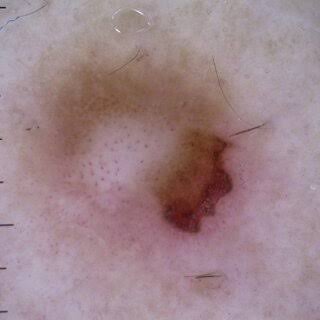 Vasos puntiformes | Imagem: Pessoa de pele clara, em plano de detalhe extremo (imagem dermatoscópica) focado em uma lesão cutânea pigmentada. A imagem exibe uma lesão assimétrica com uma área periférica de pigmentação castanha clara e difusa. No quadrante inferior direito, destaca-se uma área excêntrica, bem delimitada, ulcerada ou crostosa, de coloração avermelhada e marrom-escura. Na porção central e mais clara da lesão, observam-se múltiplos pequenos pontos escuros (pontos cinza-azulados ou aberturas foliculares). Poucos fios de cabelo finos e curtos cruzam a superfície. No topo, há uma pequena bolha de ar decorrente do gel de interface e, na borda lateral esquerda, pequenos traços pretos indicam uma escala milimétrica de medição. A iluminação é focada e uniforme, típica do exame dermatoscópico.