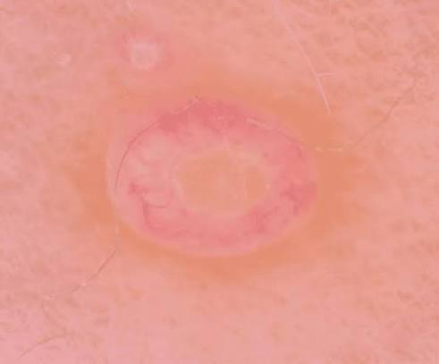 Vasos arboriformes | Imagem: Pessoa de pele clara, em plano de detalhe extremo (imagem dermatoscópica) focado em uma lesão cutânea. A imagem exibe uma estrutura anular e arredondada, caracterizada por uma borda externa eritematosa (avermelhada) e ligeiramente saliente, com finos vasos lineares visíveis sob magnificação. O centro da lesão apresenta uma área circular mais clara, de tom amarelado ou pálido e textura lisa. A pele ao redor exibe tonalidade rosada uniforme. Poucos traços de fios de cabelo muito finos e claros cruzam a periferia da imagem, que possui iluminação direta, focada e homogênea.
