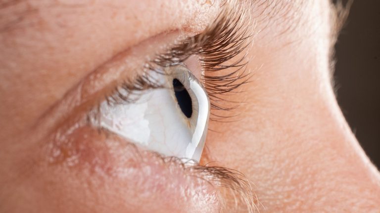 Ceratocone: Sinais Clínicos e Indicação de Crosslinking